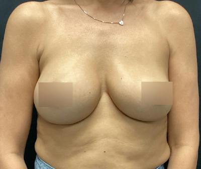 Breast Augmentation Before & After Gallery - Patient 255714 - Image 1