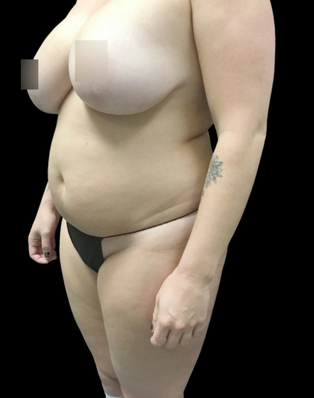 Tight Sculpt with Liposuction Before & After Gallery - Patient 380924 - Image 3