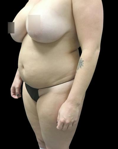 Tight Sculpt with Liposuction Before & After Gallery - Patient 380924 - Image 3
