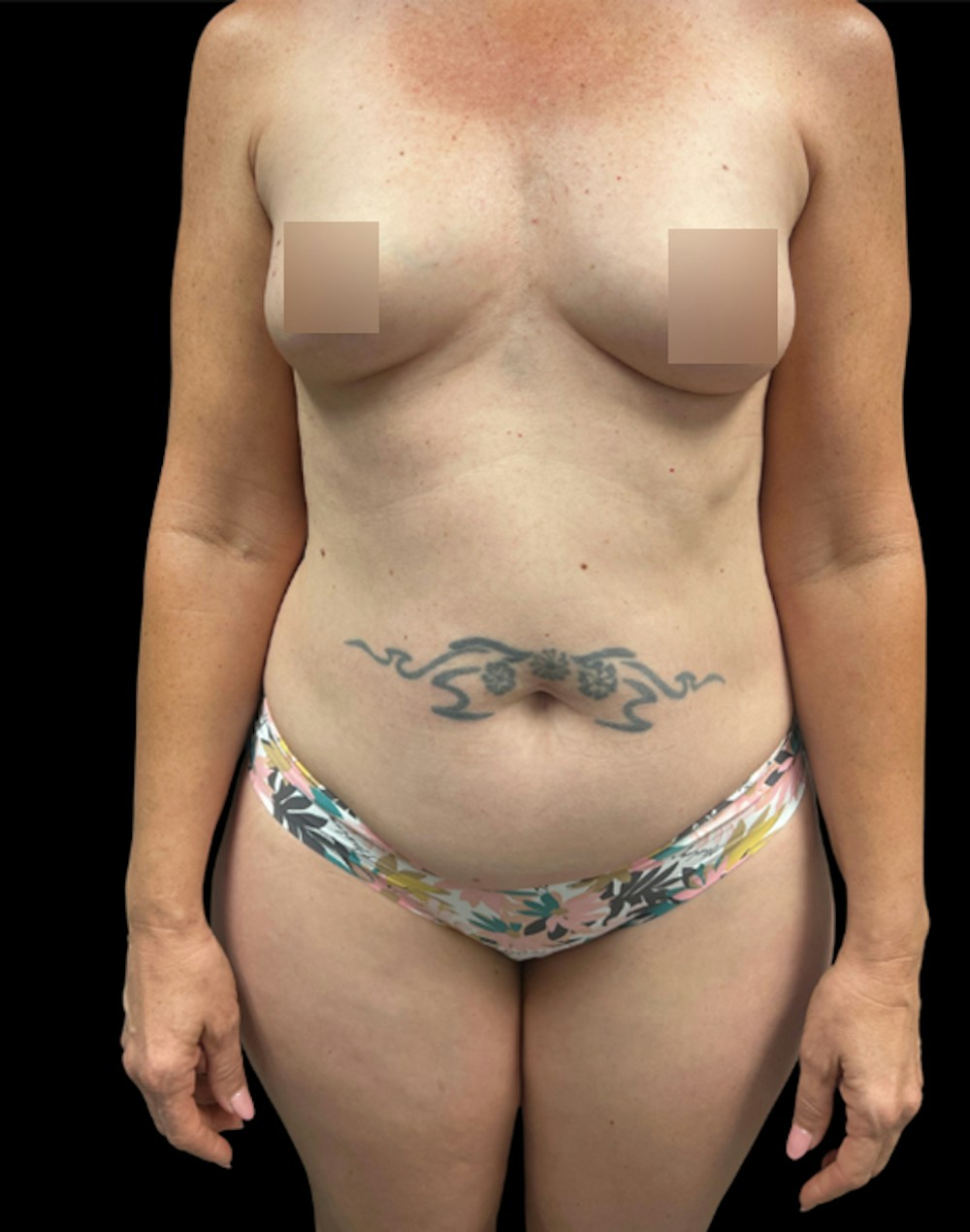 Tight Sculpt with Liposuction Before & After Gallery - Patient 154263 - Image 1