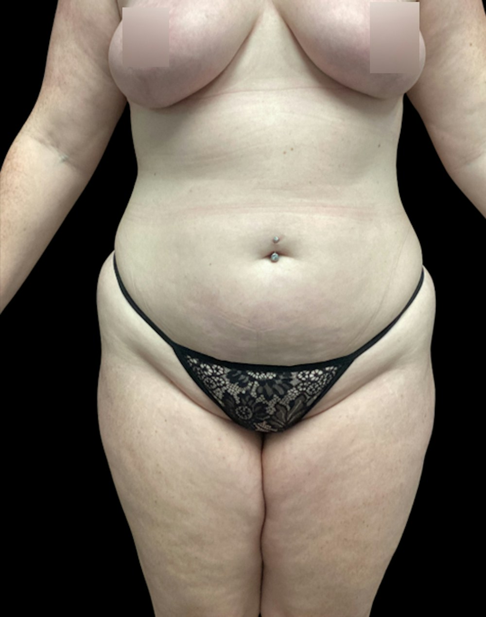 Tight Sculpt with Liposuction Before & After Gallery - Patient 721222 - Image 1