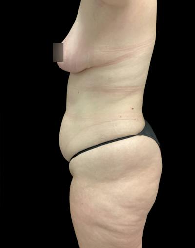 Tight Sculpt with Liposuction Before & After Gallery - Patient 721222 - Image 5
