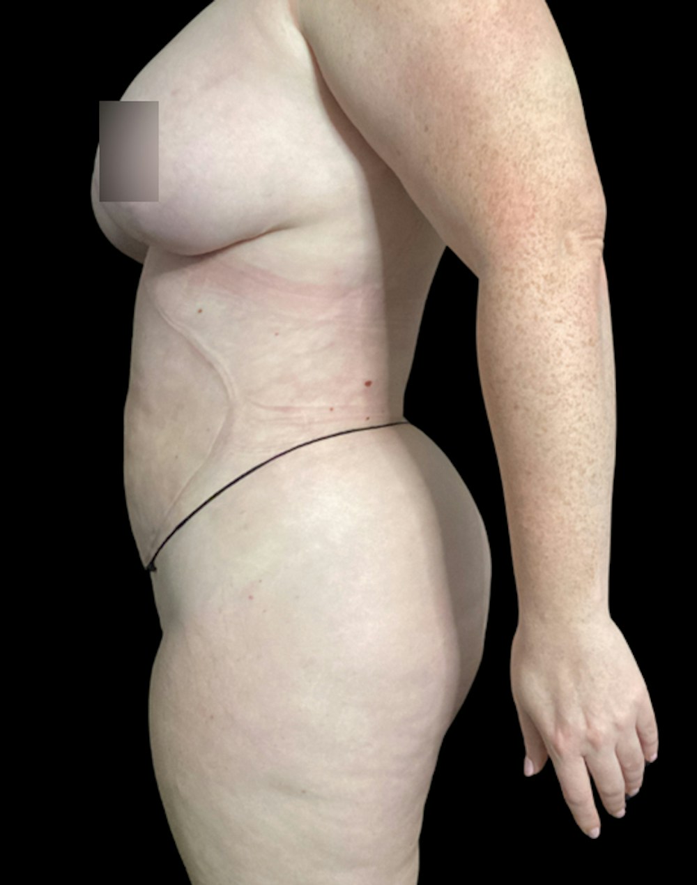 Tight Sculpt with Liposuction Before & After Gallery - Patient 721222 - Image 6