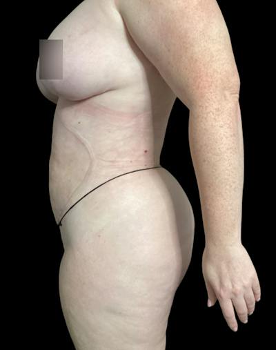 Tight Sculpt with Liposuction Before & After Gallery - Patient 721222 - Image 6