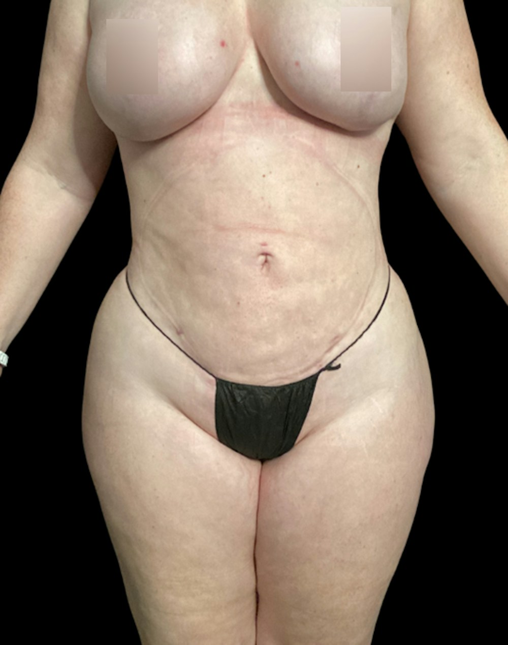 Tight Sculpt with Liposuction Before & After Gallery - Patient 721222 - Image 2