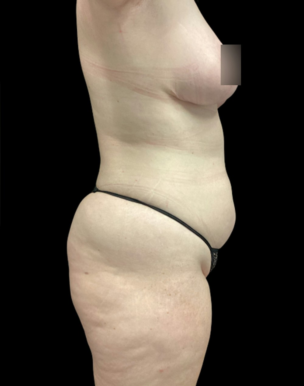 Tight Sculpt with Liposuction Before & After Gallery - Patient 721222 - Image 7
