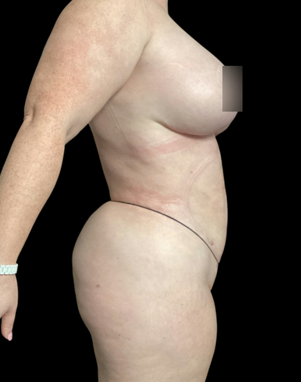 Tight Sculpt with Liposuction Before & After Gallery - Patient 721222 - Image 8