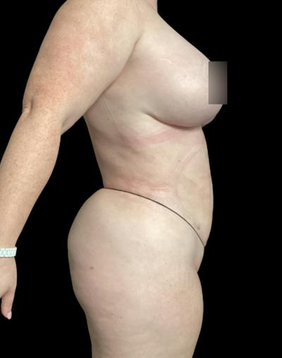 Tight Sculpt with Liposuction Before & After Gallery - Patient 721222 - Image 8