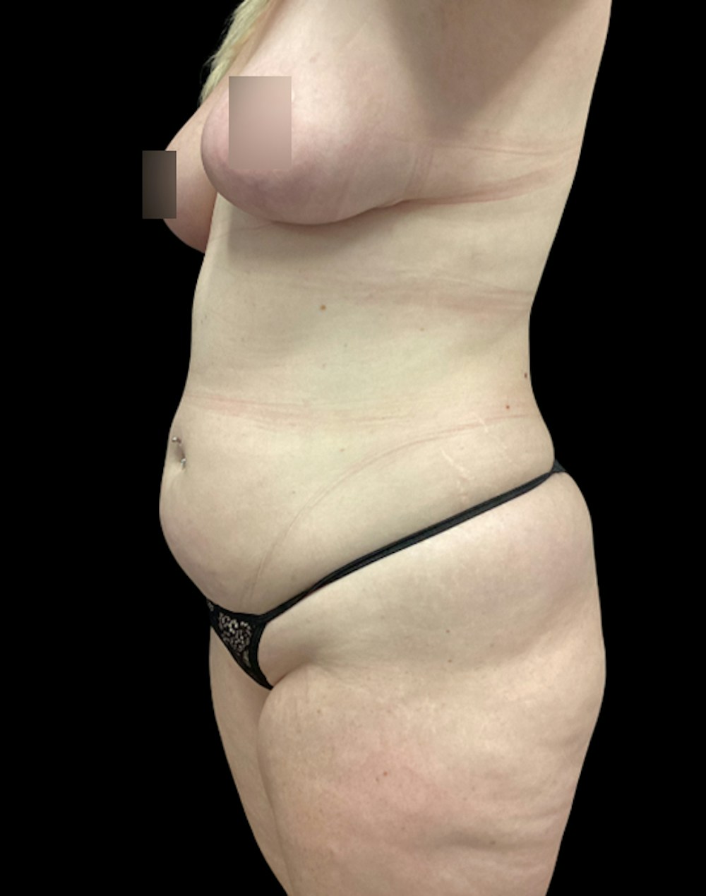 Tight Sculpt with Liposuction Before & After Gallery - Patient 721222 - Image 3