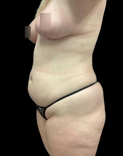 Tight Sculpt with Liposuction Before & After Gallery - Patient 721222 - Image 3