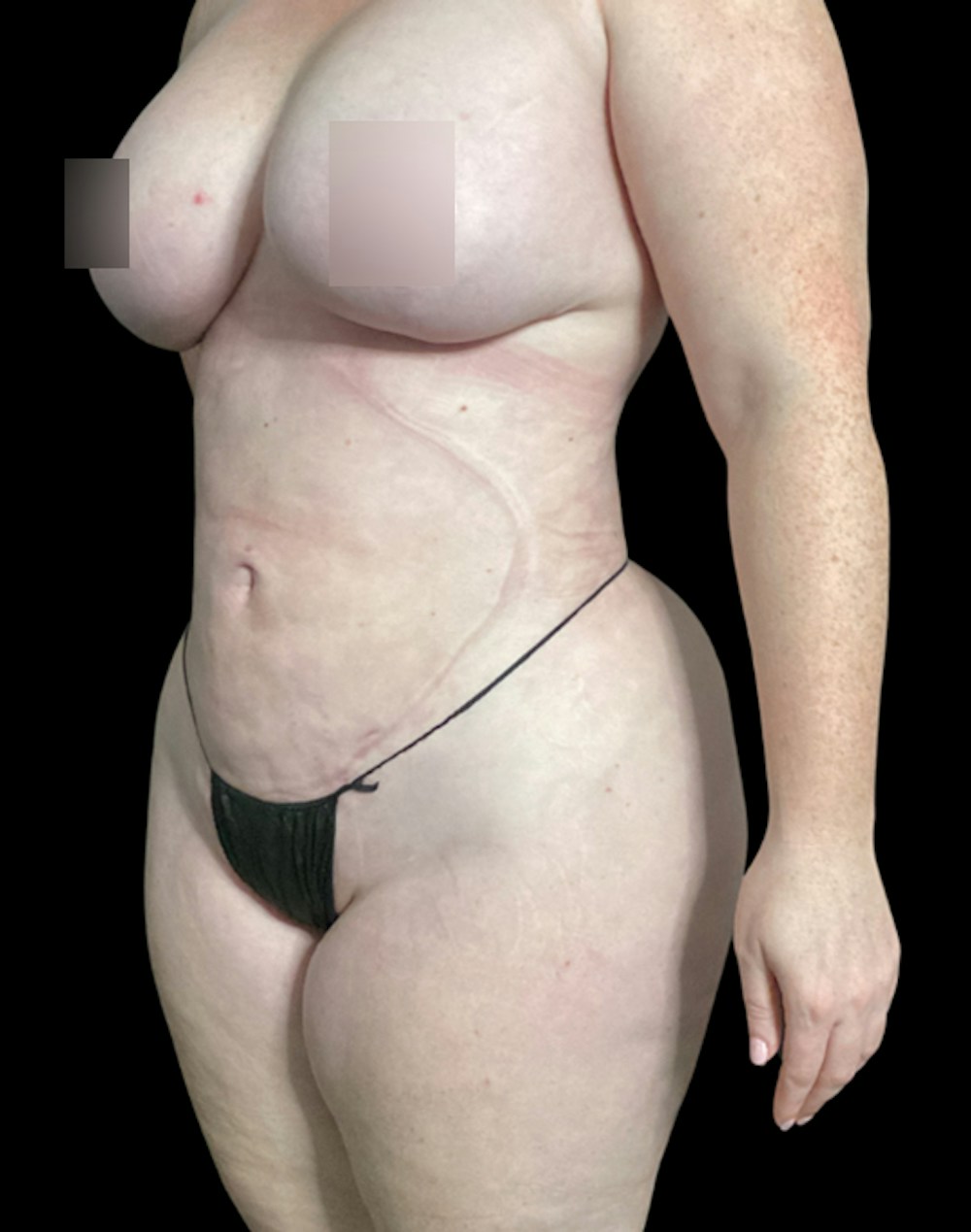 Tight Sculpt with Liposuction Before & After Gallery - Patient 721222 - Image 4