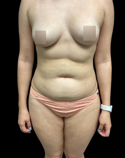 Tight Sculpt with Liposuction Before & After Gallery - Patient 394664 - Image 1