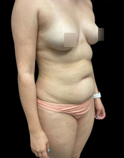 Tight Sculpt with Liposuction Before & After Gallery - Patient 394664 - Image 3