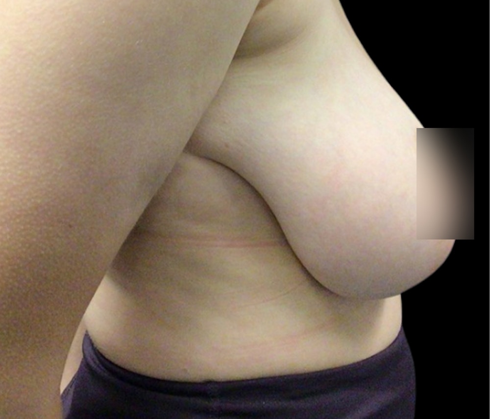 Breast Lift Before & After Gallery - Patient 318824 - Image 3