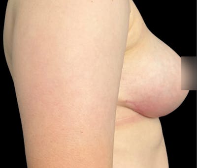 Breast Lift Before & After Gallery - Patient 318824 - Image 4