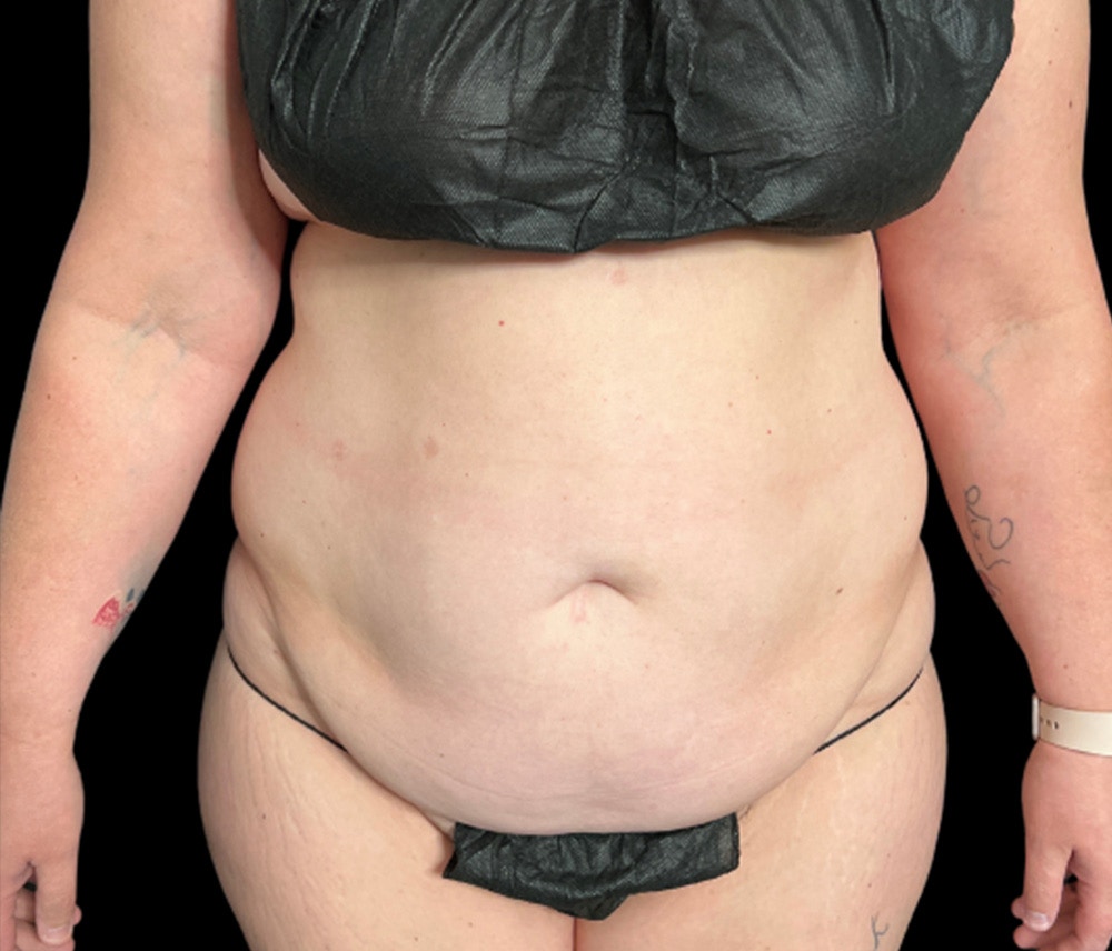 Liposuction Before & After Gallery - Patient 307677 - Image 1