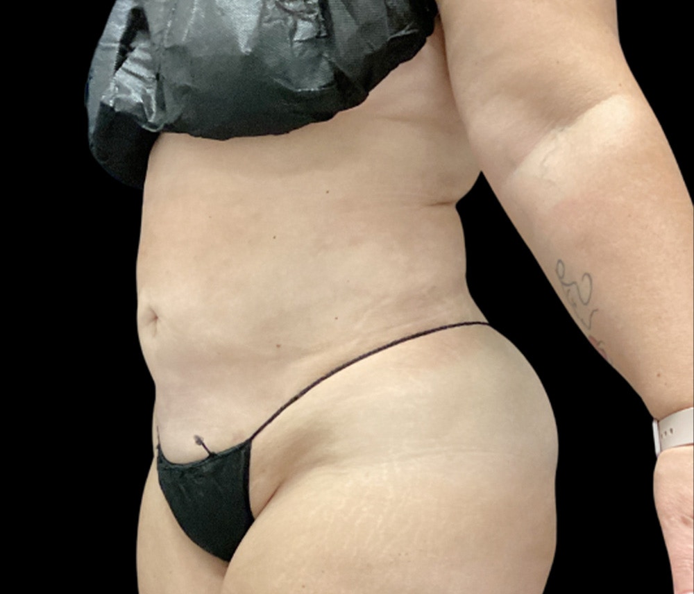 Liposuction Before & After Gallery - Patient 307677 - Image 4