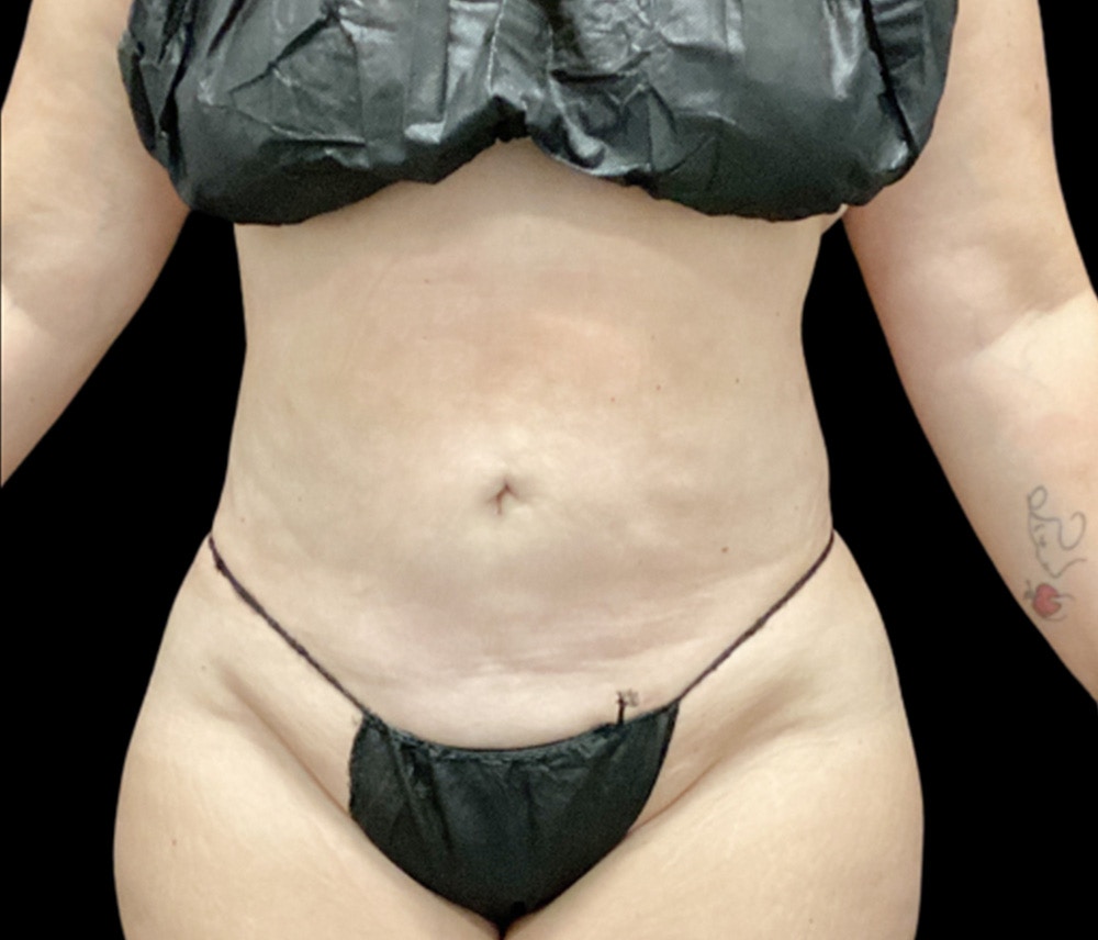 Liposuction Before & After Gallery - Patient 307677 - Image 2