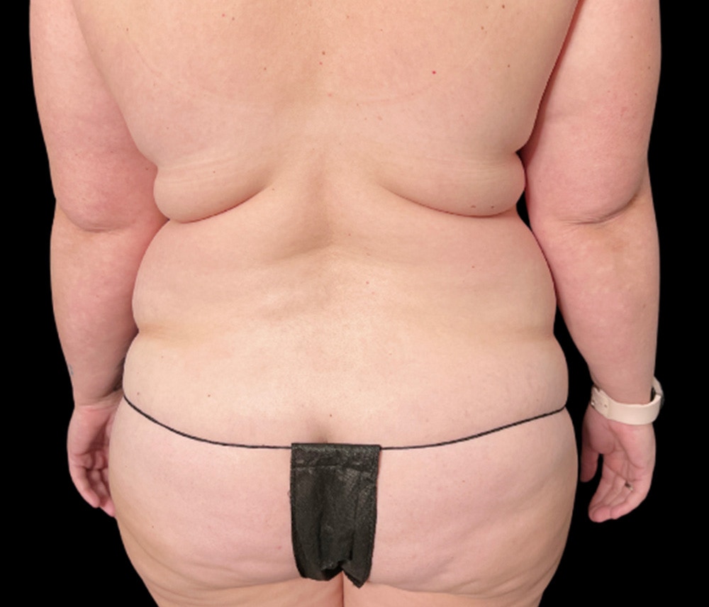 Liposuction Before & After Gallery - Patient 307677 - Image 5