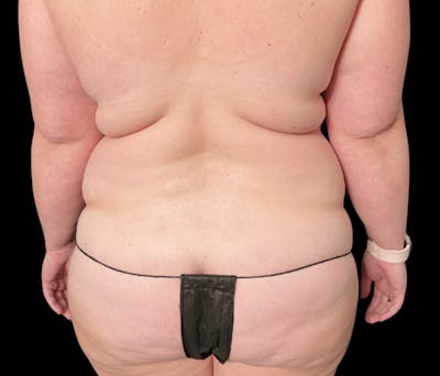 Liposuction Before & After Gallery - Patient 307677 - Image 5