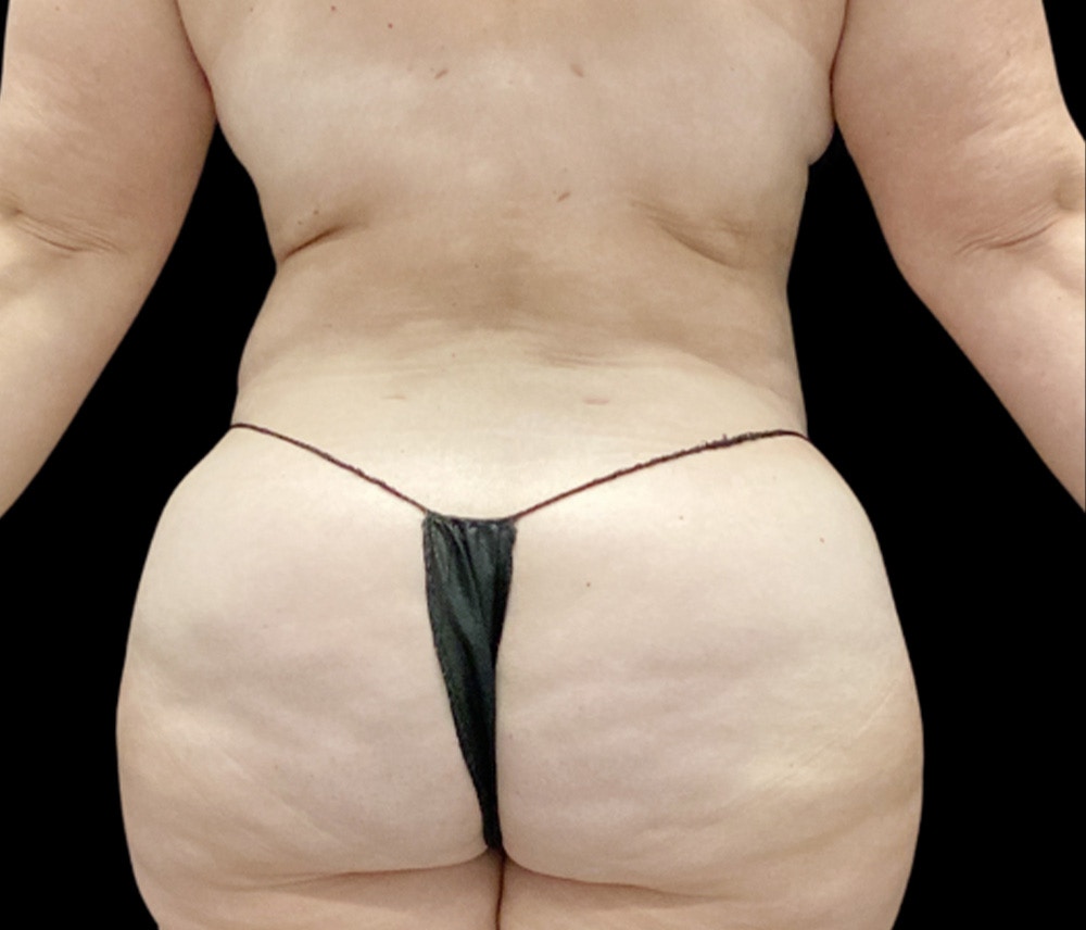 Liposuction Before & After Gallery - Patient 307677 - Image 6