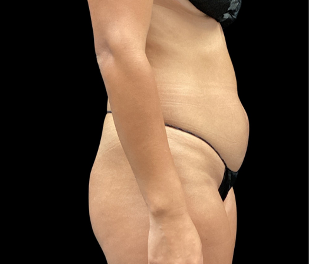 Liposuction Before & After Gallery - Patient 401792 - Image 5