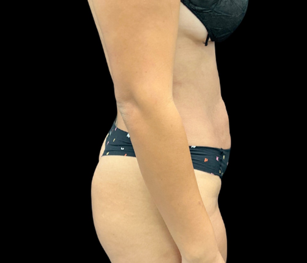 Liposuction Before & After Gallery - Patient 401792 - Image 6