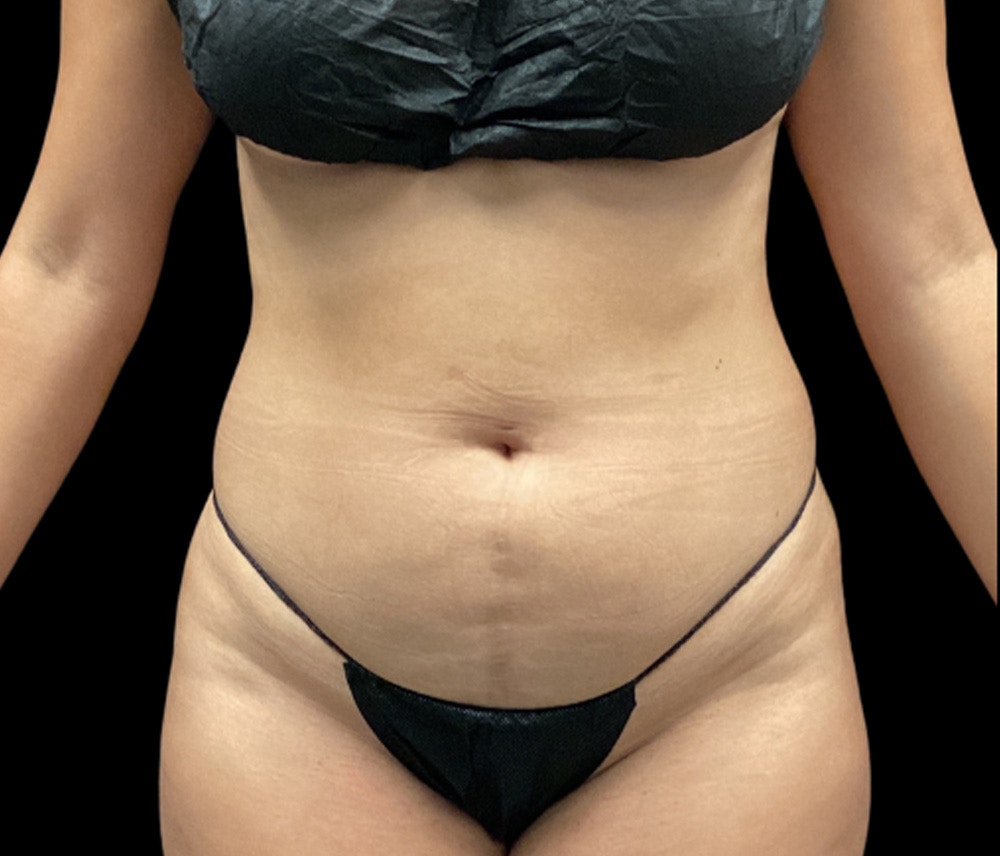 Liposuction Before & After Gallery - Patient 401792 - Image 1