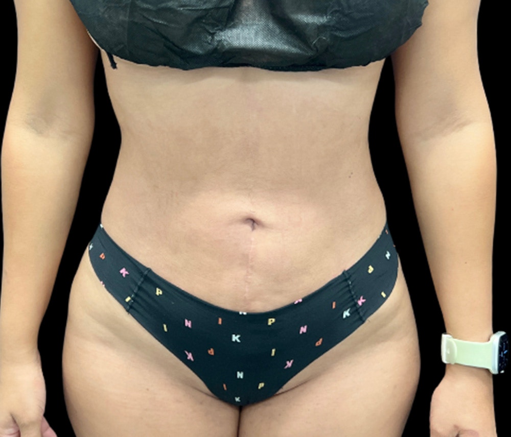 Liposuction Before & After Gallery - Patient 401792 - Image 2