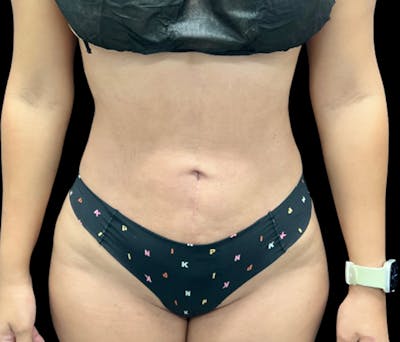 Liposuction Before & After Gallery - Patient 401792 - Image 2