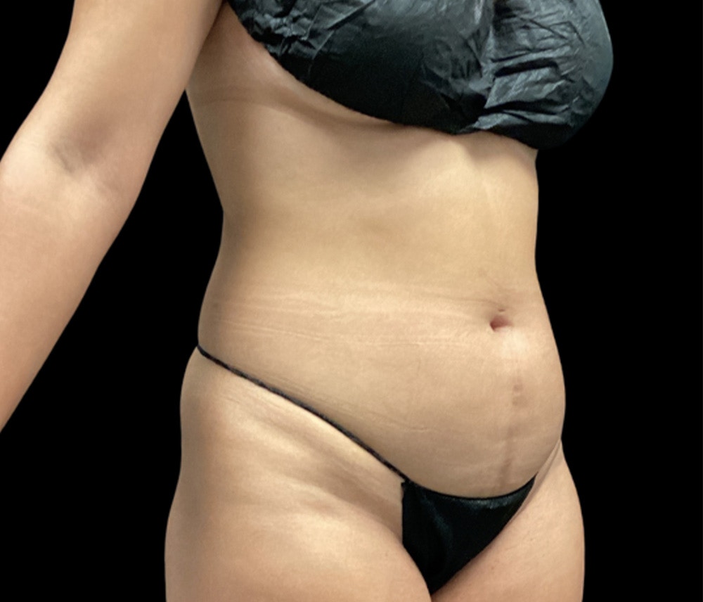 Liposuction Before & After Gallery - Patient 401792 - Image 3