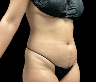 Liposuction Before & After Gallery - Patient 401792 - Image 3