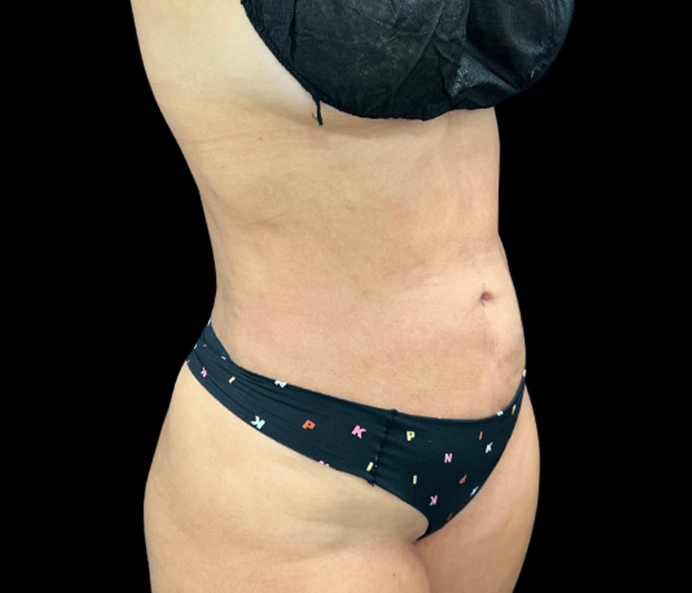 Liposuction Before & After Gallery - Patient 401792 - Image 4