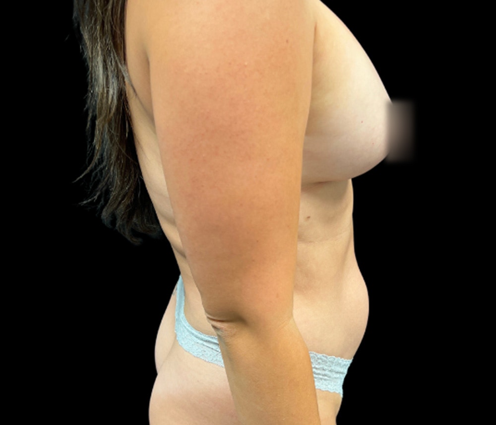 Liposuction Before & After Gallery - Patient 798221 - Image 5