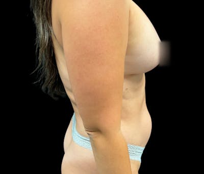 Liposuction Before & After Gallery - Patient 798221 - Image 5