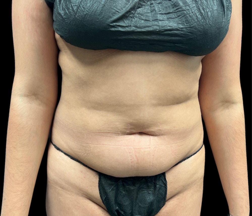 Liposuction Before & After Gallery - Patient 374399 - Image 1