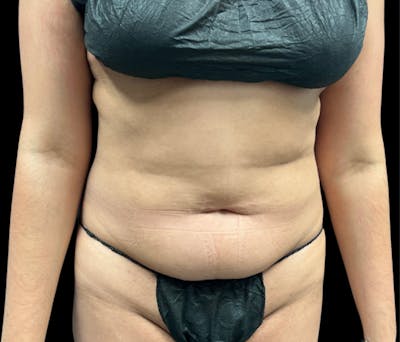 Liposuction Before & After Gallery - Patient 374399 - Image 1