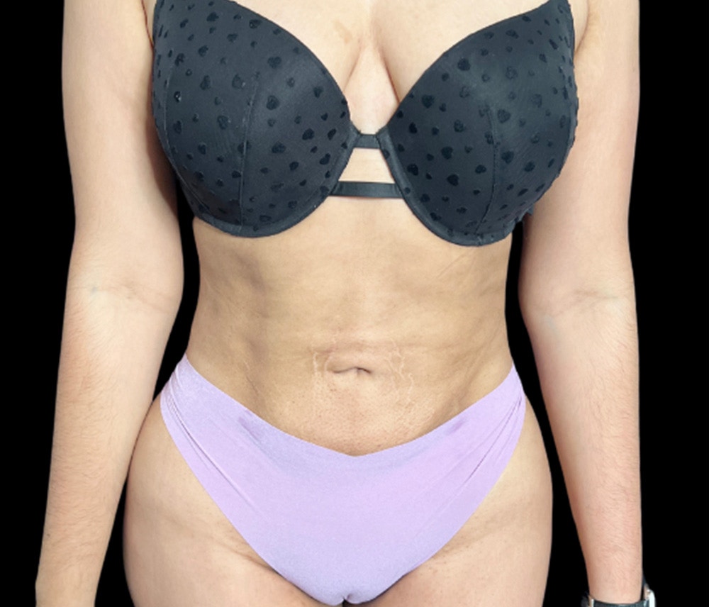 Liposuction Before & After Gallery - Patient 374399 - Image 2