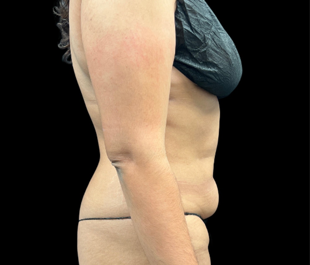 Liposuction Before & After Gallery - Patient 374399 - Image 5