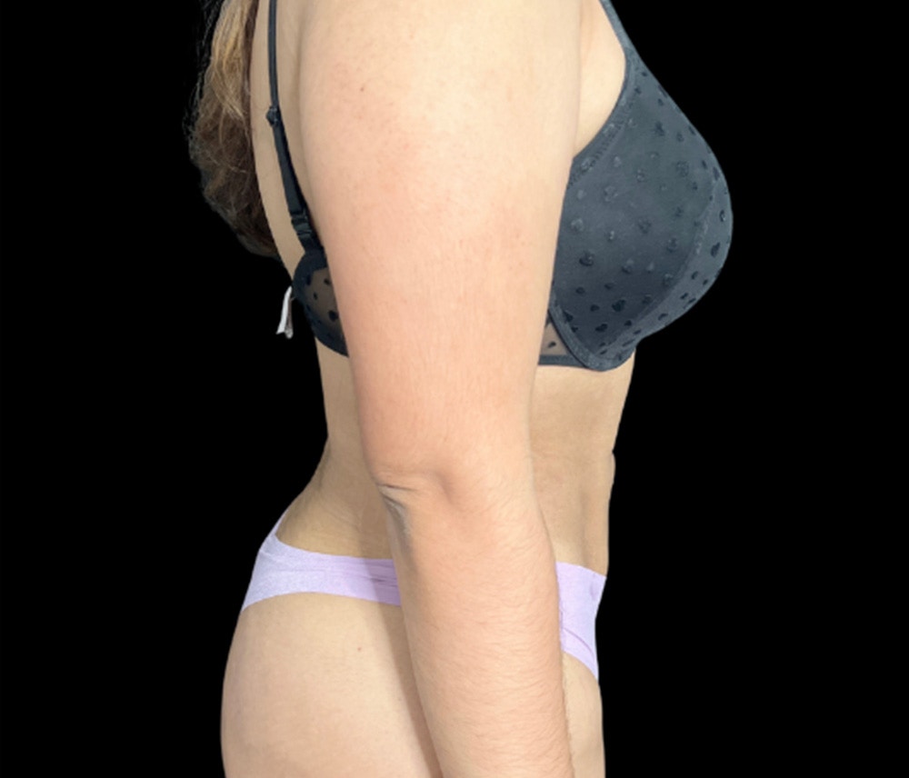 Liposuction Before & After Gallery - Patient 374399 - Image 6