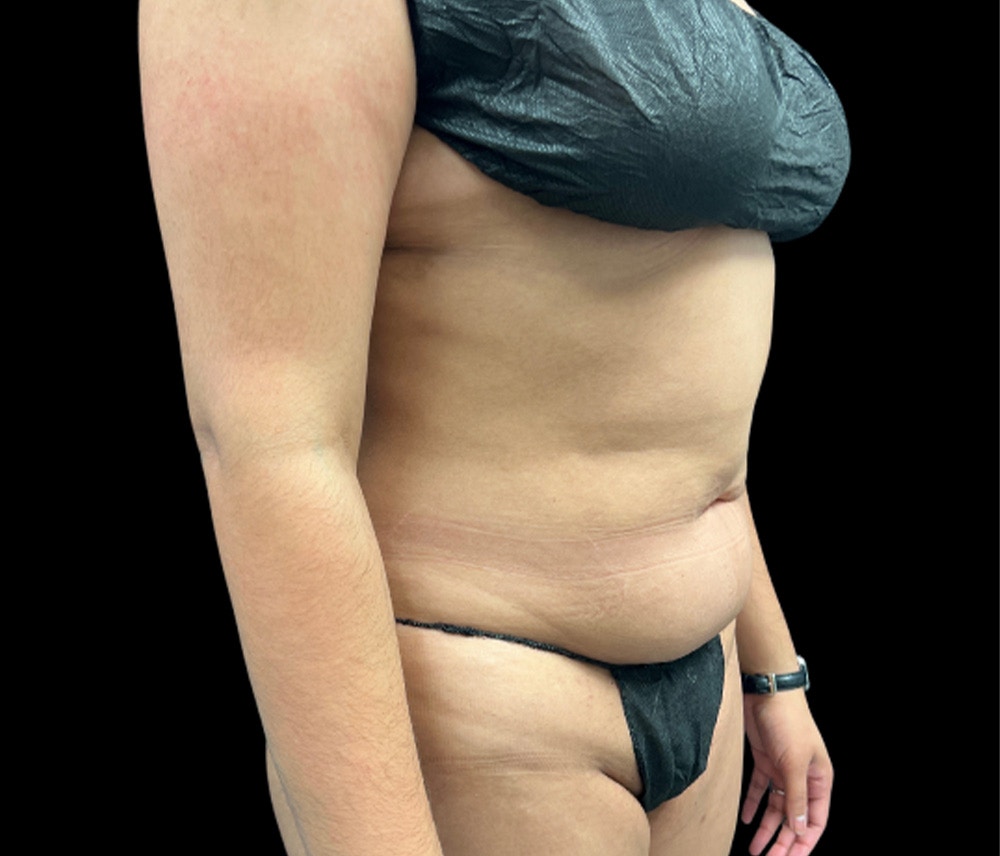 Liposuction Before & After Gallery - Patient 374399 - Image 3