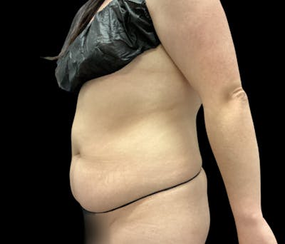 Liposuction Before & After Gallery - Patient 854557 - Image 3
