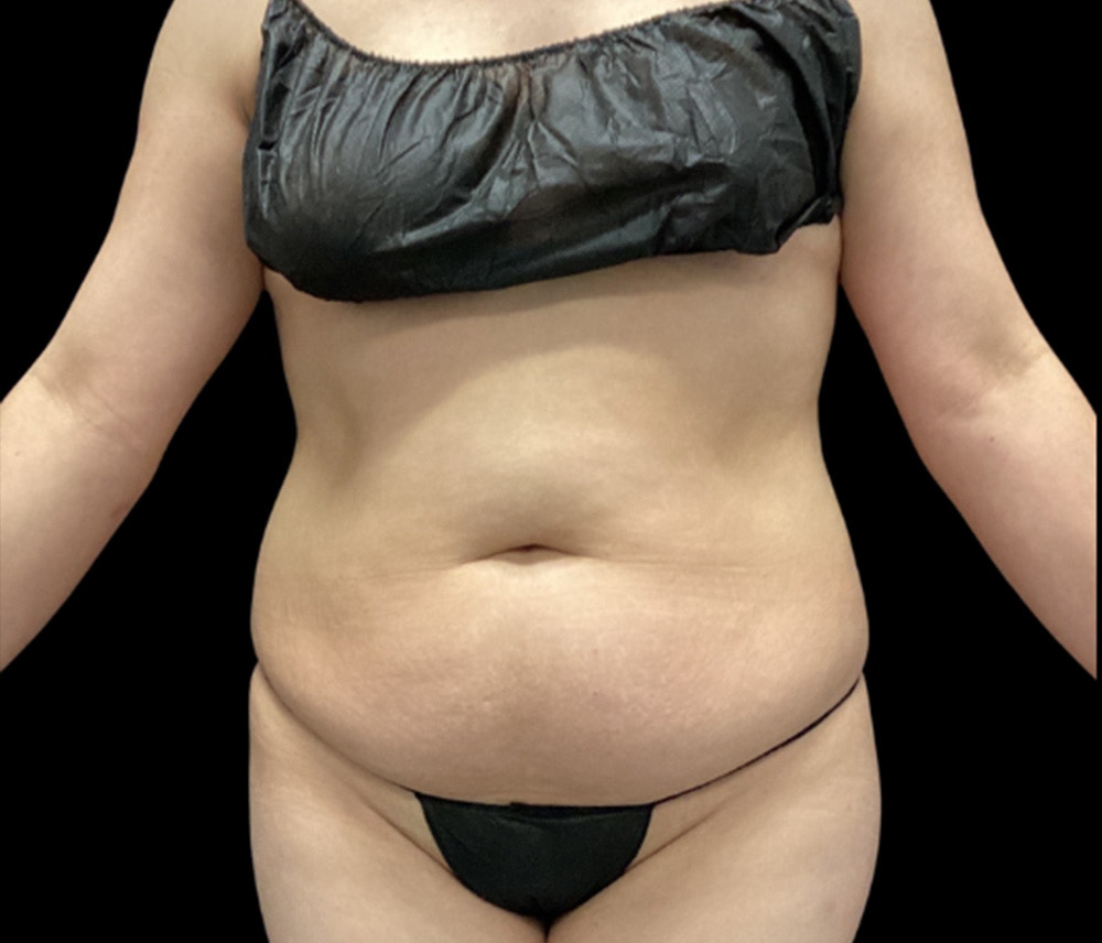 Liposuction Before & After Gallery - Patient 854557 - Image 1