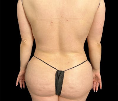 Liposuction Before & After Gallery - Patient 854557 - Image 6