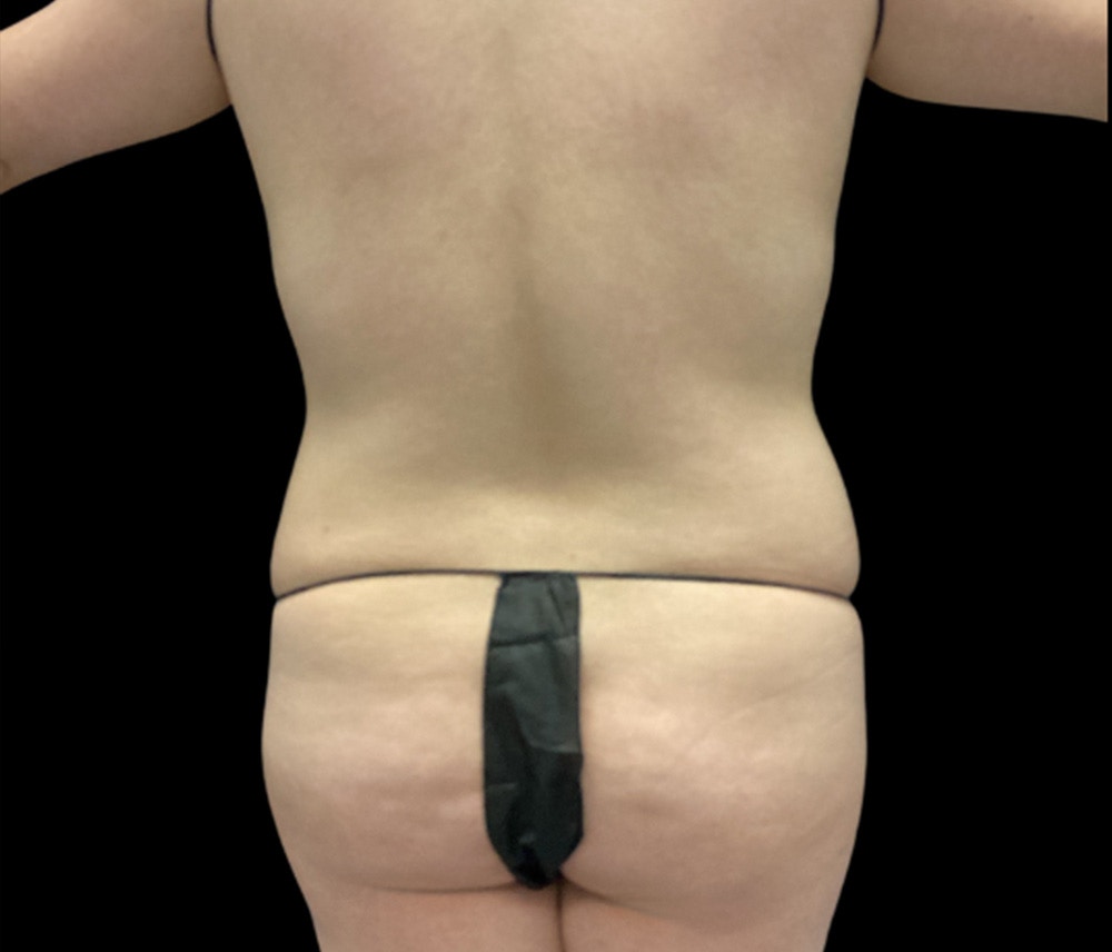 Liposuction Before & After Gallery - Patient 854557 - Image 5