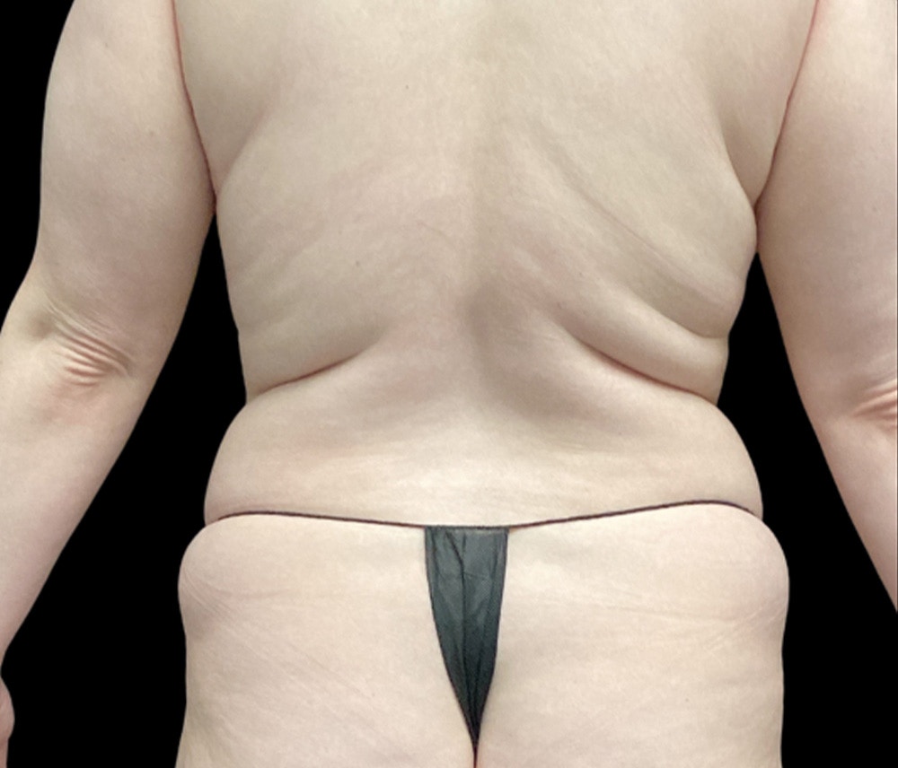 Liposuction Before & After Gallery - Patient 385572 - Image 5