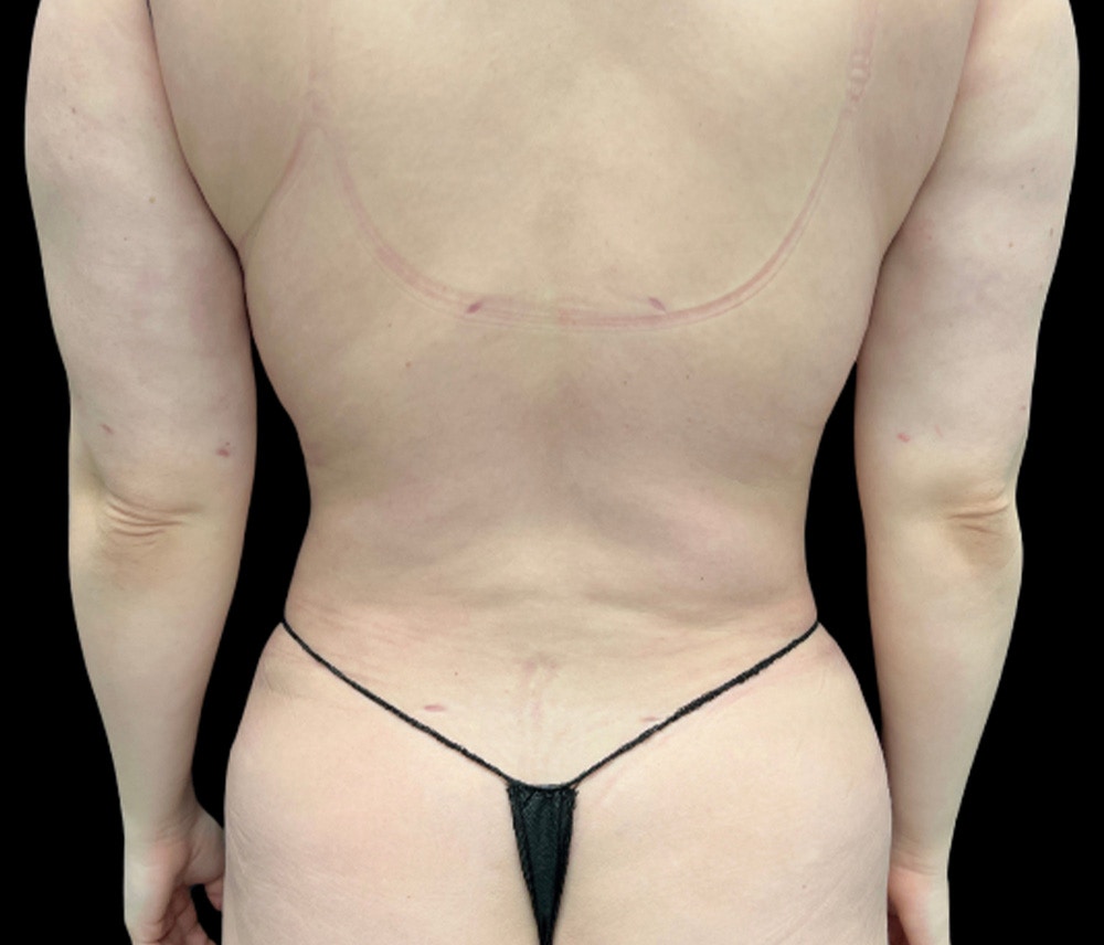 Liposuction Before & After Gallery - Patient 385572 - Image 6