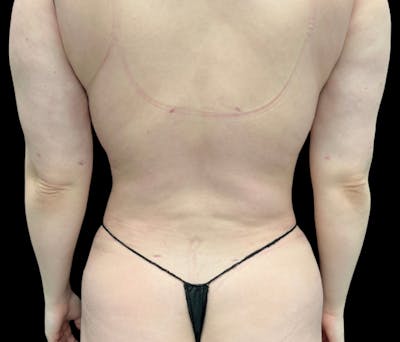 Liposuction Before & After Gallery - Patient 385572 - Image 6