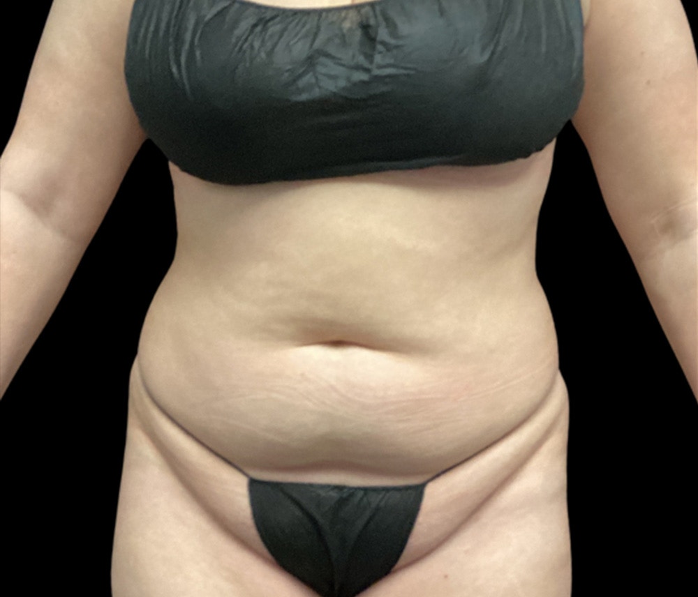 Liposuction Before & After Gallery - Patient 385572 - Image 1