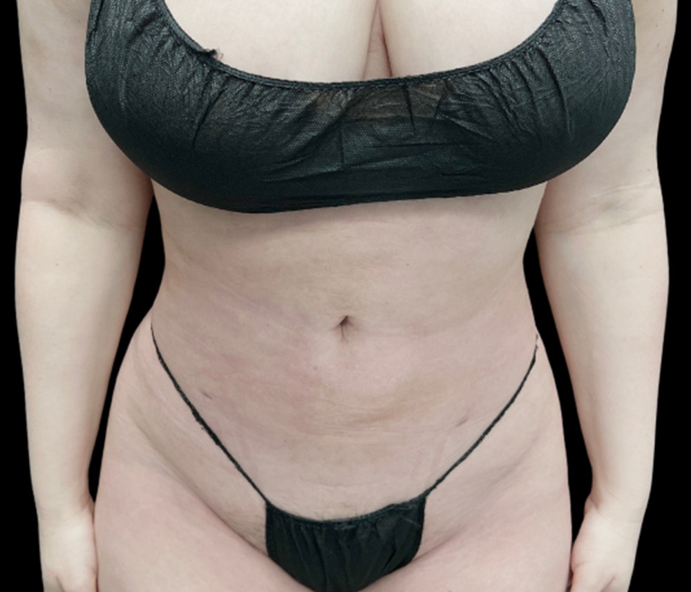 Liposuction Before & After Gallery - Patient 385572 - Image 2